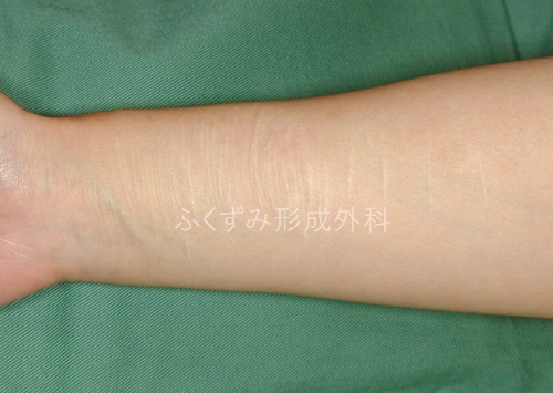 症例写真です リストカット痕に対するレーザー治療 フラクショナル レーザー モザイク Eco2 2回 大阪市中央区天満橋 ふくずみ形成外科 ふくずみ形成外科院長のちょっと気になるお話し