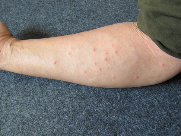 赤い ない 斑点 痒く に 腕 痒くない蕁麻疹(じんましん)の14の症状と対処法！